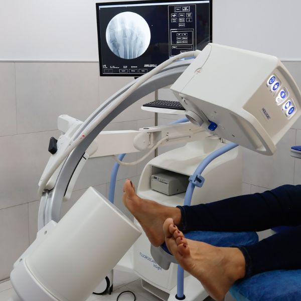 Radiografía digital de los pies de una paciente para el diagnóstico de juanetes en clínica podológica