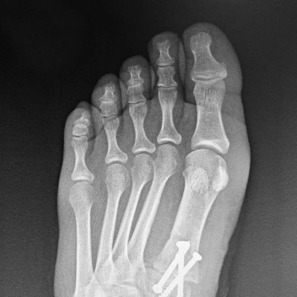 radiografia de pie con juanete