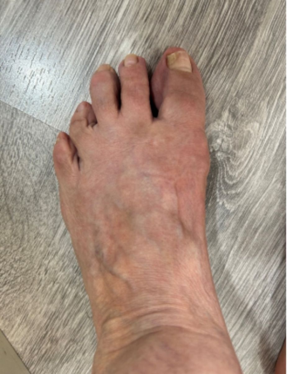 casos reales juanetes alicante (1)