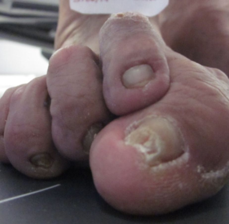 casos reales juanetes alicante (10)