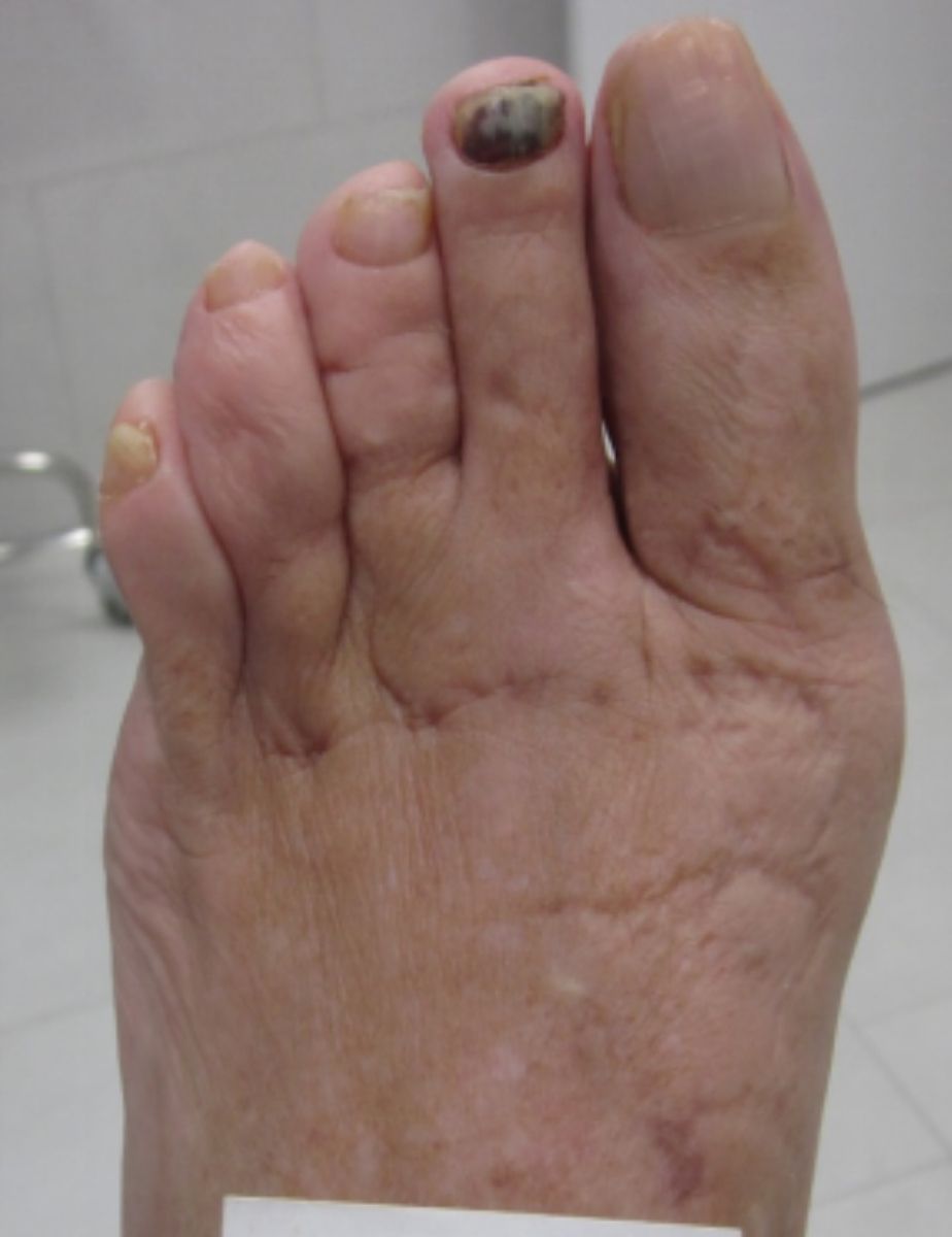 casos reales juanetes alicante (3)