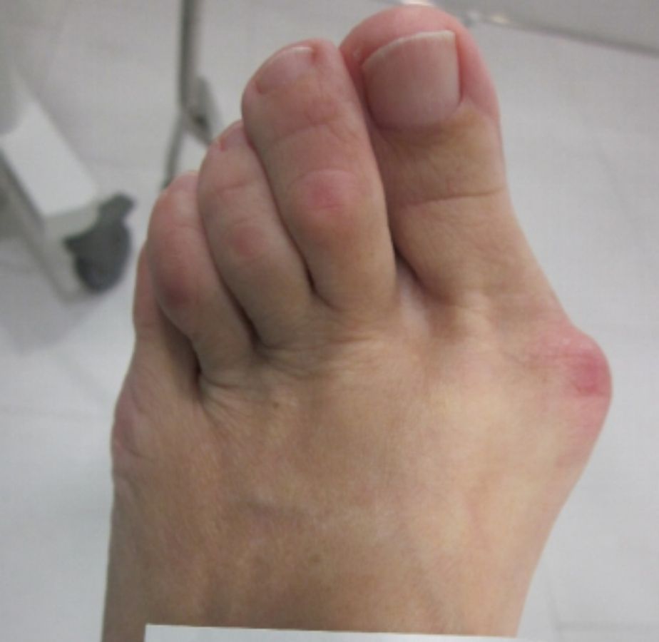 casos reales juanetes alicante (4)