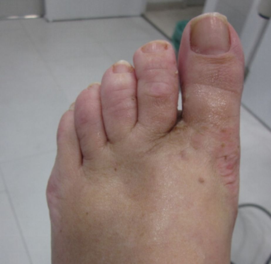 casos reales juanetes alicante (5)