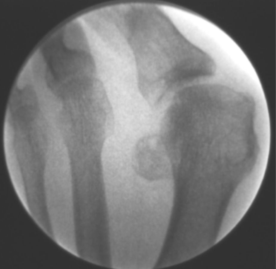 casos reales juanetes alicante (6)