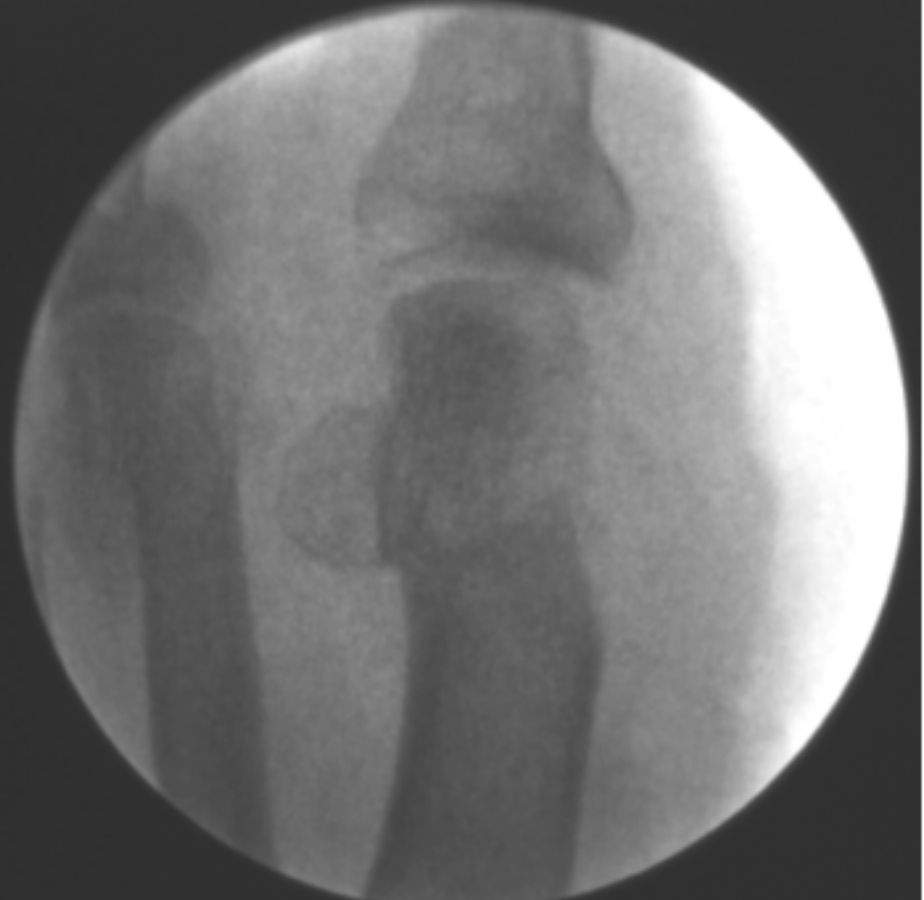 casos reales juanetes alicante (7)