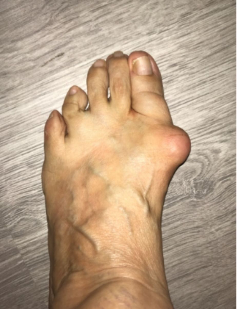 casos reales juanetes alicante